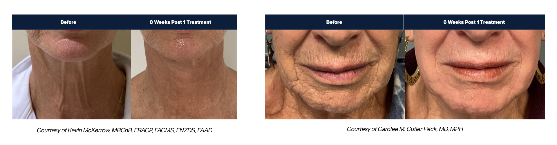 Laser-Coring Landing Page