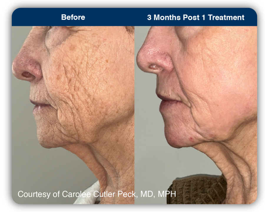 UltraClear_B&A_Fine Lines & Wrinkles 3