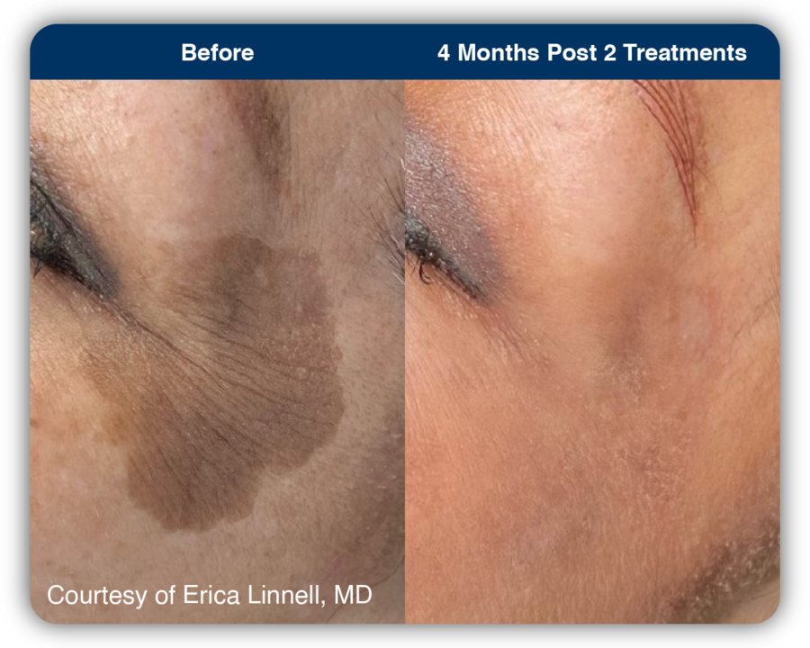 UltraClear_B&A_Pigmentation 1