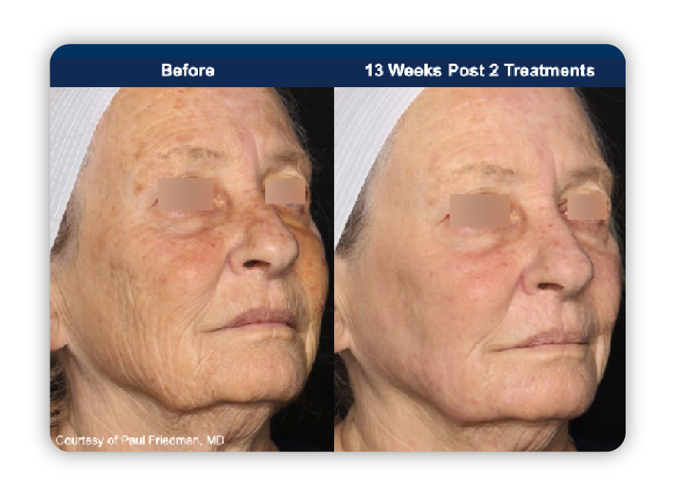 202604 before and after 1