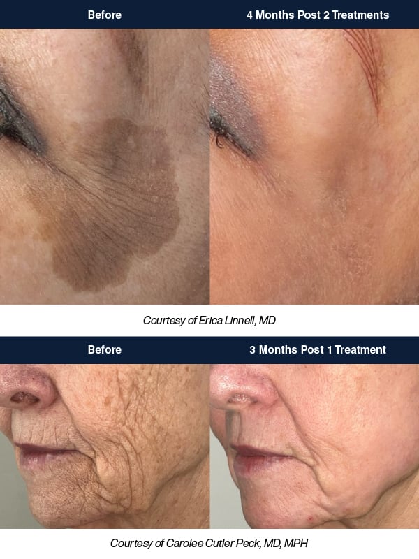 20260821 Skin Medical Acclaro EDGE_zz eBlast Before and After