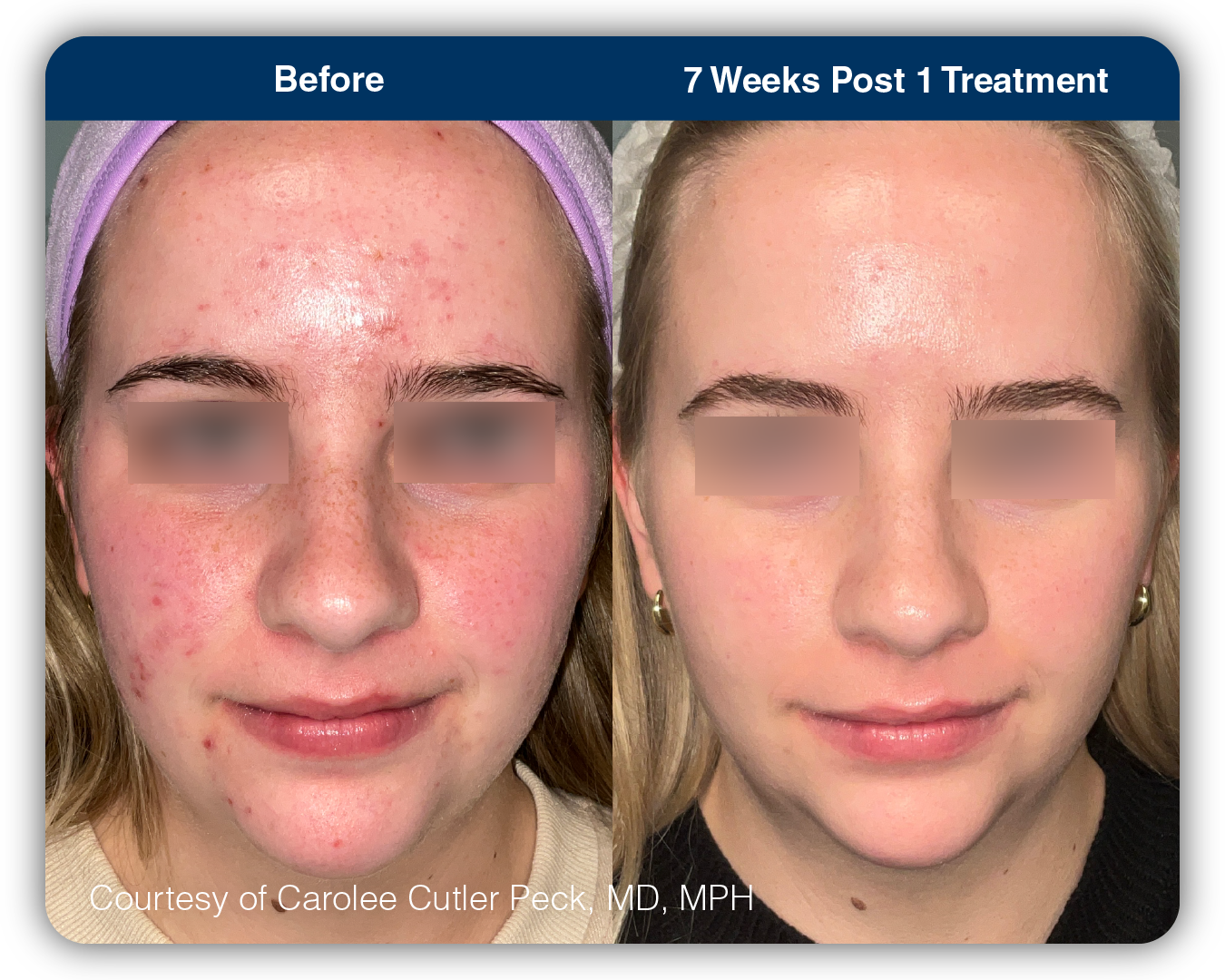 UltraClear_B&A_AcneScars_10 UltraClear_B&A_AcneScars_10